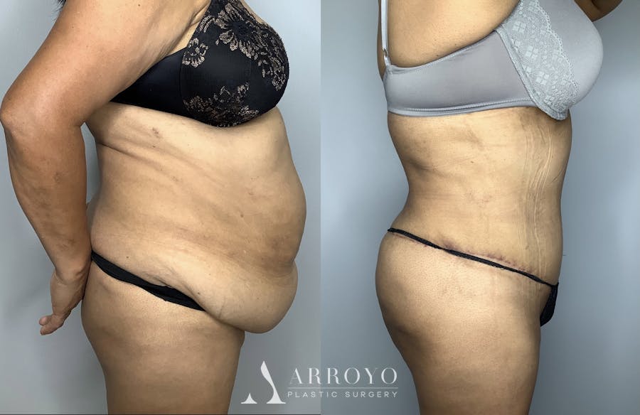 Brazilian Butt Lift Before & After Gallery - Patient 66768243 - Image 6