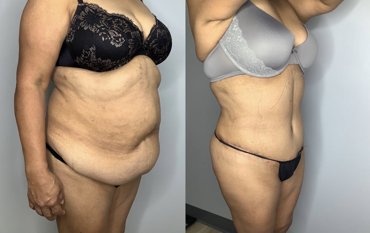 Tummy Tuck Before & After Gallery - Patient 66768190 - Image 5