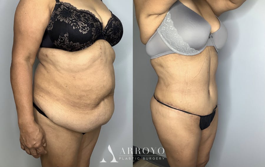 Brazilian Butt Lift Before & After Gallery - Patient 66768243 - Image 5