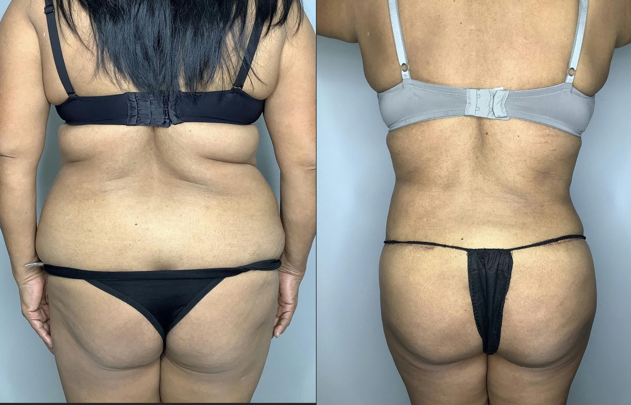 Liposuction Gallery - Patient 66768227 - Image 4