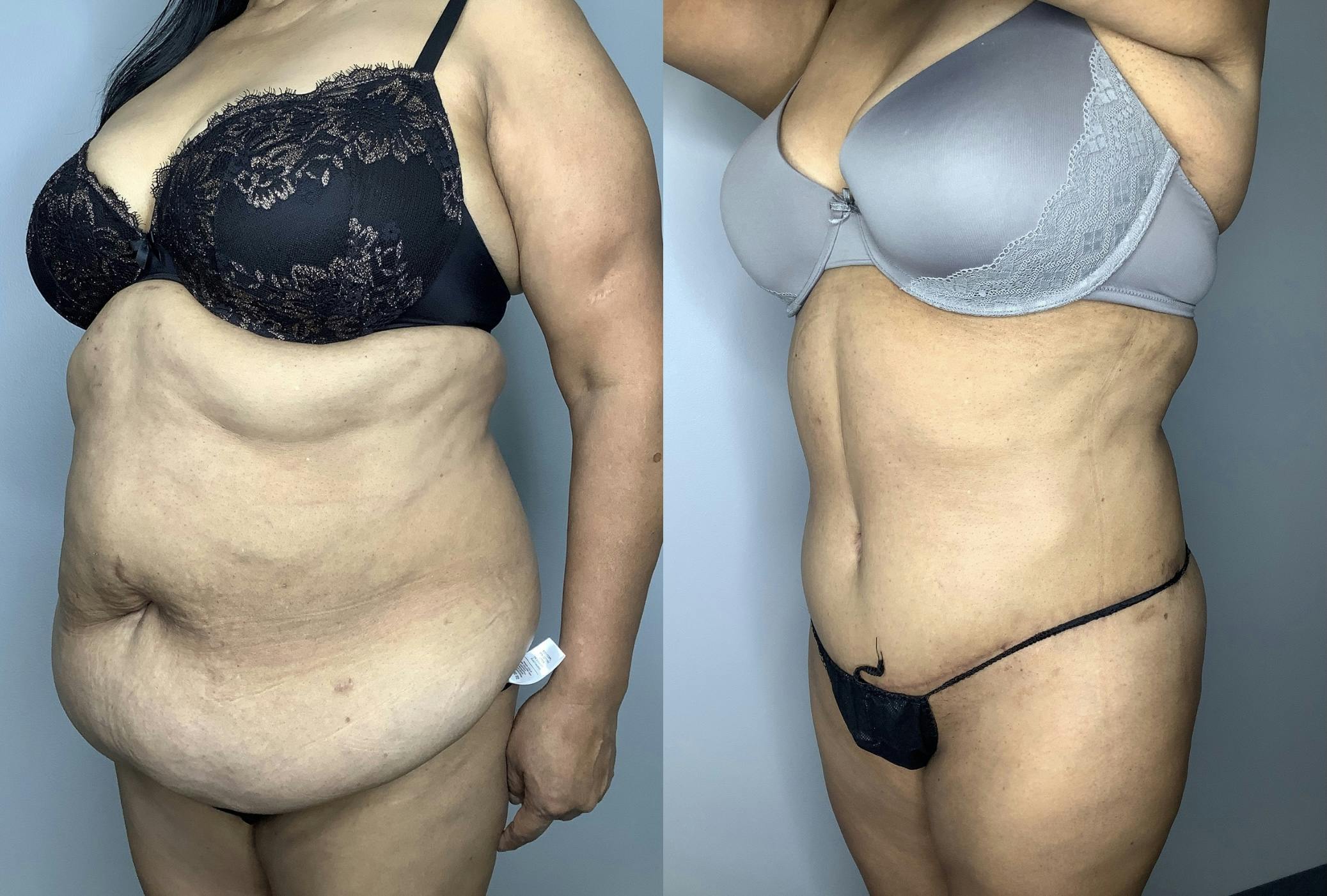 Brazilian Butt Lift Before & After Gallery - Patient 66768243 - Image 2
