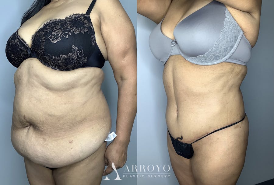 Brazilian Butt Lift Before & After Gallery - Patient 66768243 - Image 2