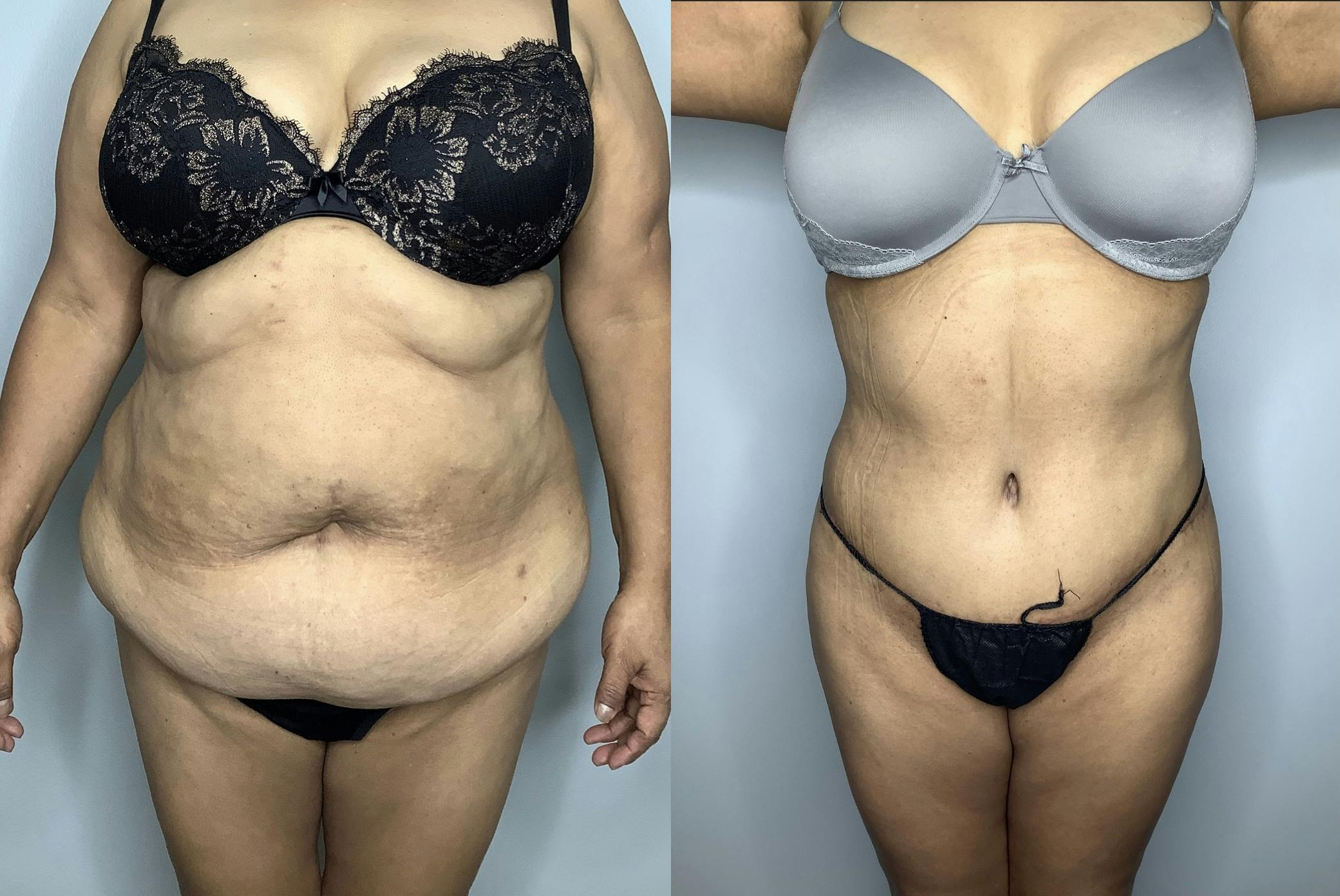 Tummy Tuck Gallery - Patient 66768190 - Image 1
