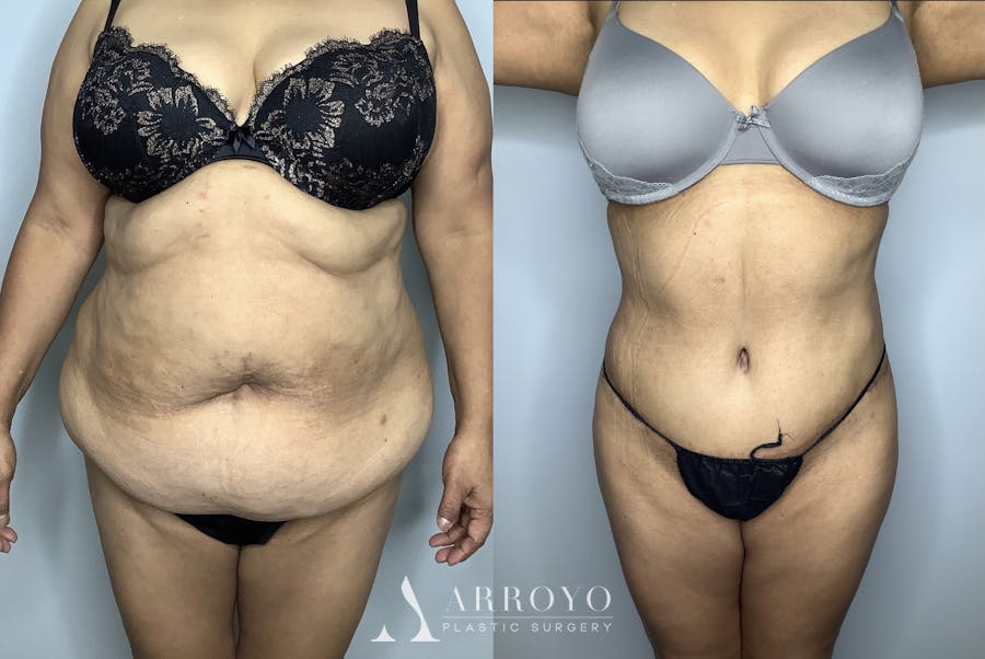 Brazilian Butt Lift Before & After Gallery - Patient 66768243 - Image 4