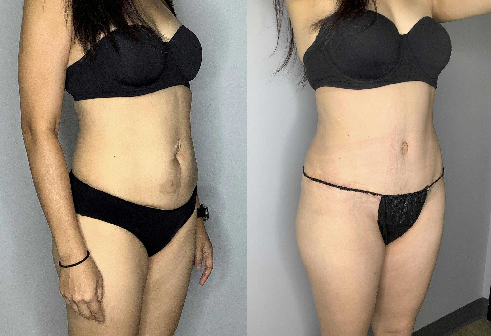 Liposuction Gallery - Patient 66768253 - Image 2