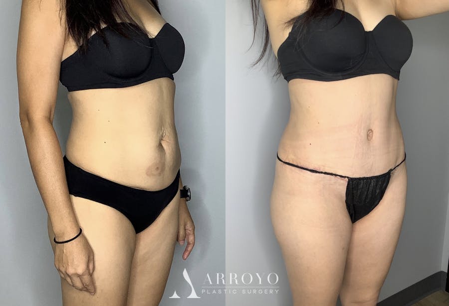 Tummy Tuck Before & After Gallery - Patient 66768254 - Image 5