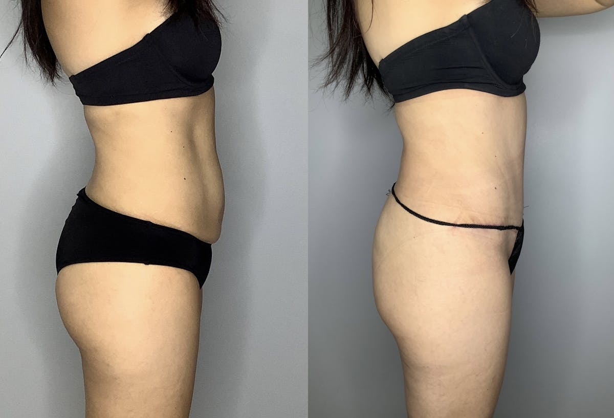 Tummy Tuck Before & After Gallery - Patient 66768254 - Image 6
