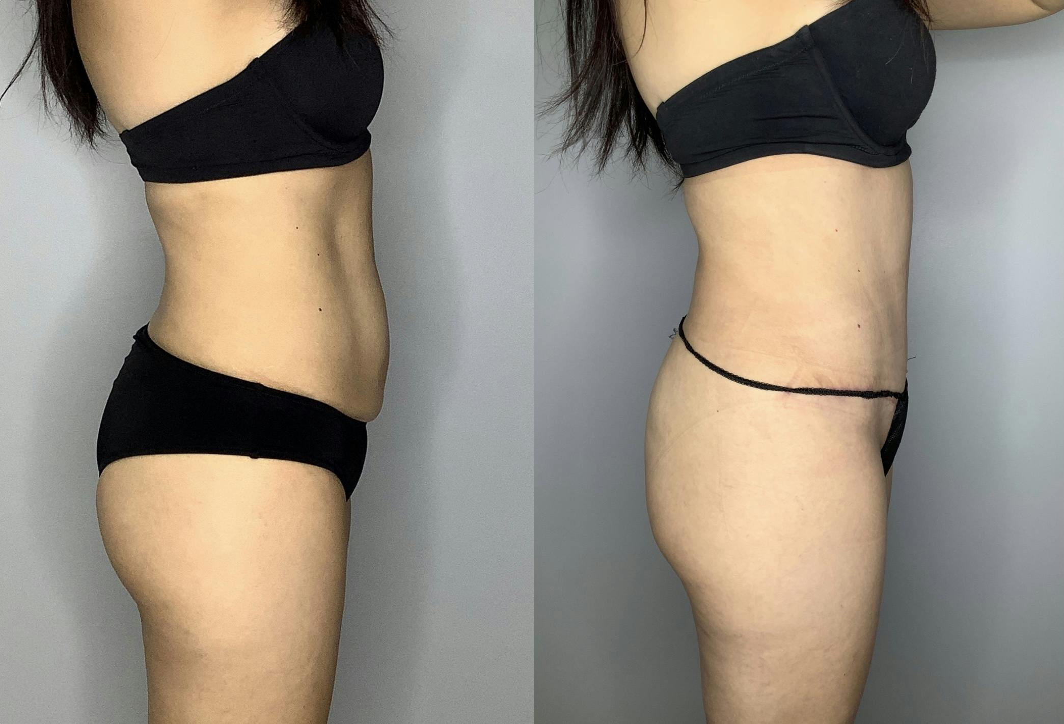 Tummy Tuck Gallery - Patient 66768254 - Image 6