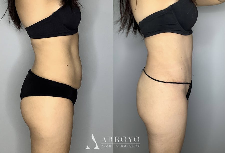 Tummy Tuck Before & After Gallery - Patient 66768254 - Image 6