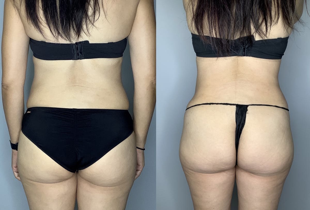 Liposuction Before & After Gallery - Patient 66768253 - Image 4