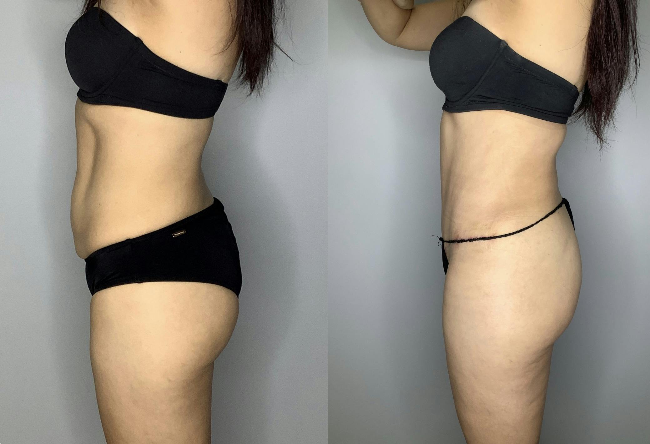 Tummy Tuck Gallery - Patient 66768254 - Image 3