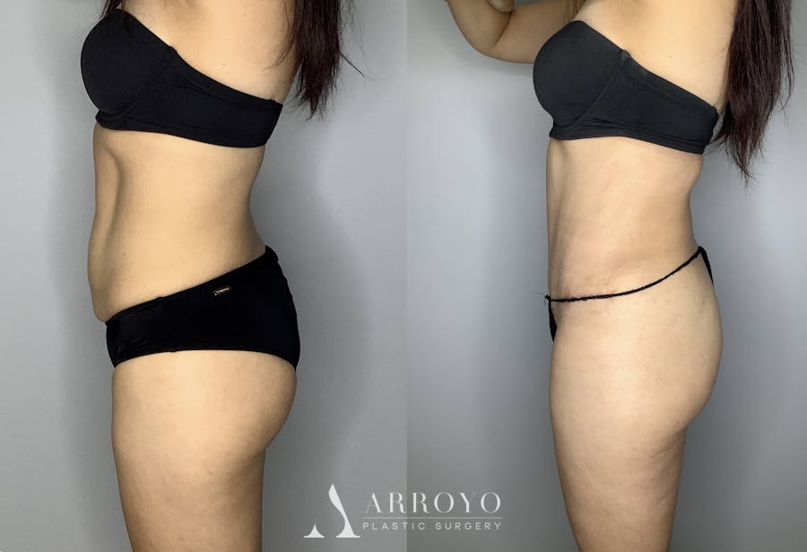 Tummy Tuck Before & After Gallery - Patient 66768254 - Image 3