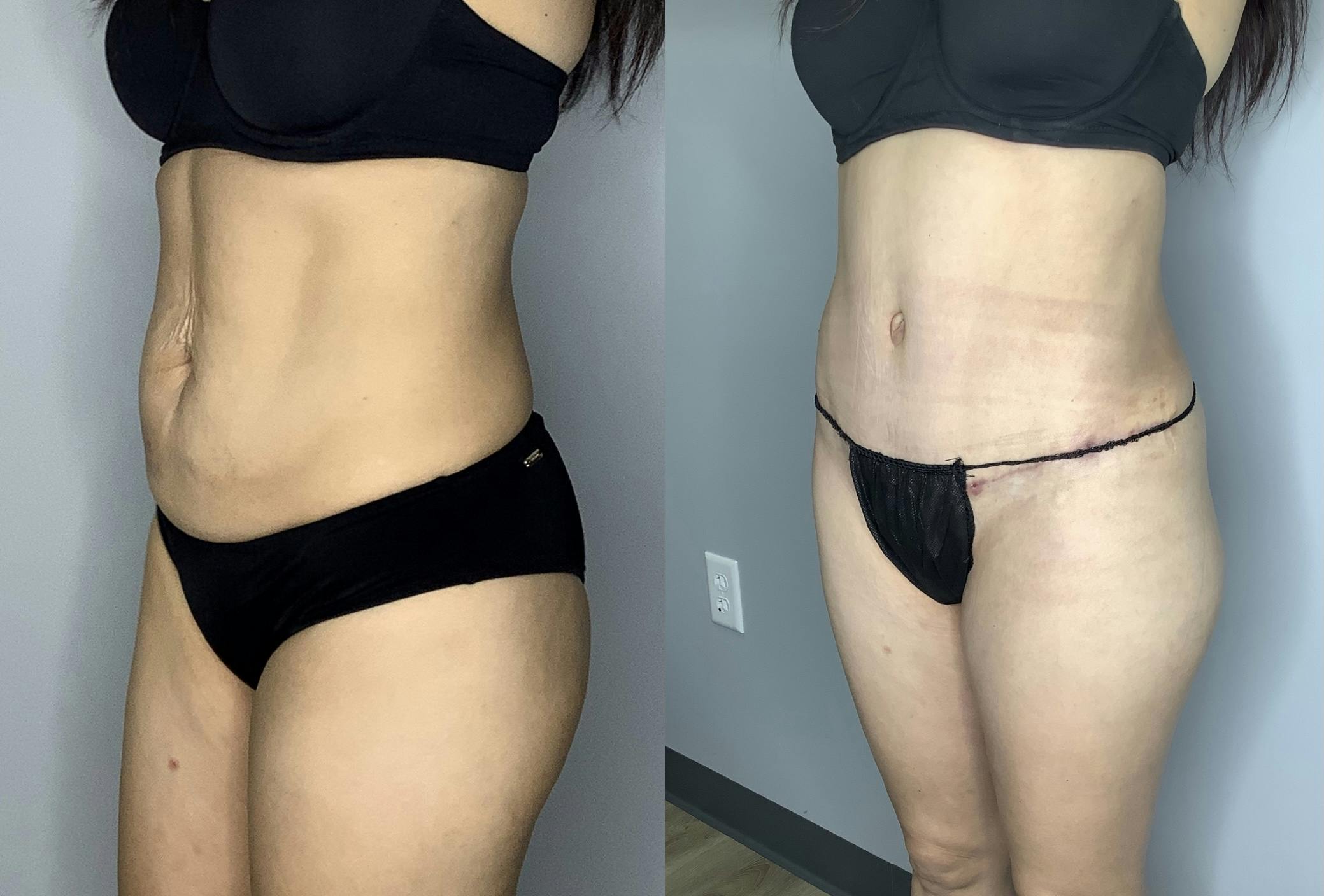 Liposuction Gallery - Patient 66768253 - Image 5