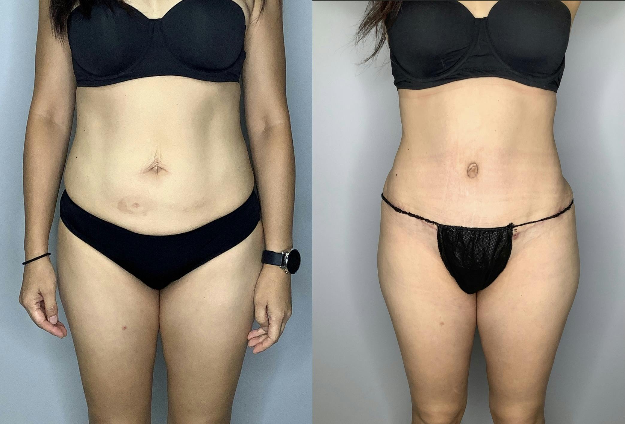Before and After Liposuction in Houston - 03