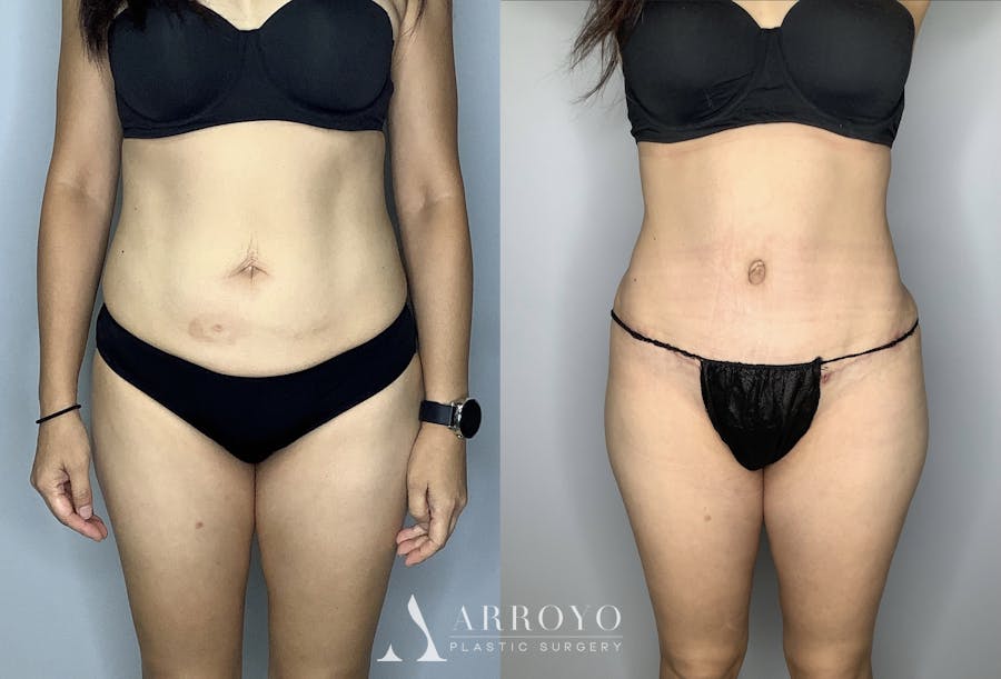 Tummy Tuck Before & After Gallery - Patient 66768254 - Image 1