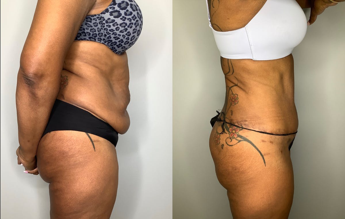 Liposuction Before & After Gallery - Patient 57580351 - Image 1