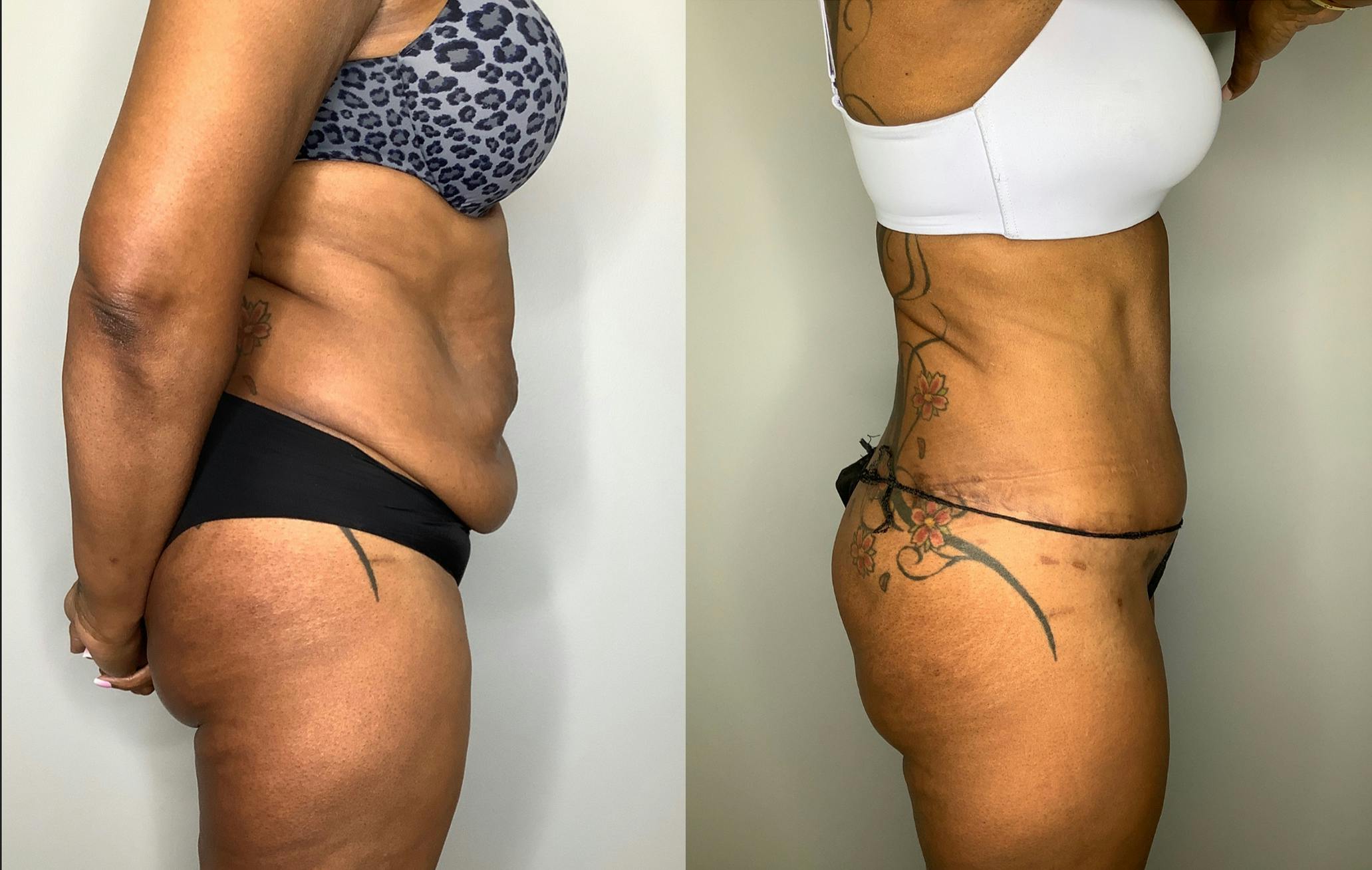 Liposuction Before & After Gallery - Patient 57580351 - Image 1