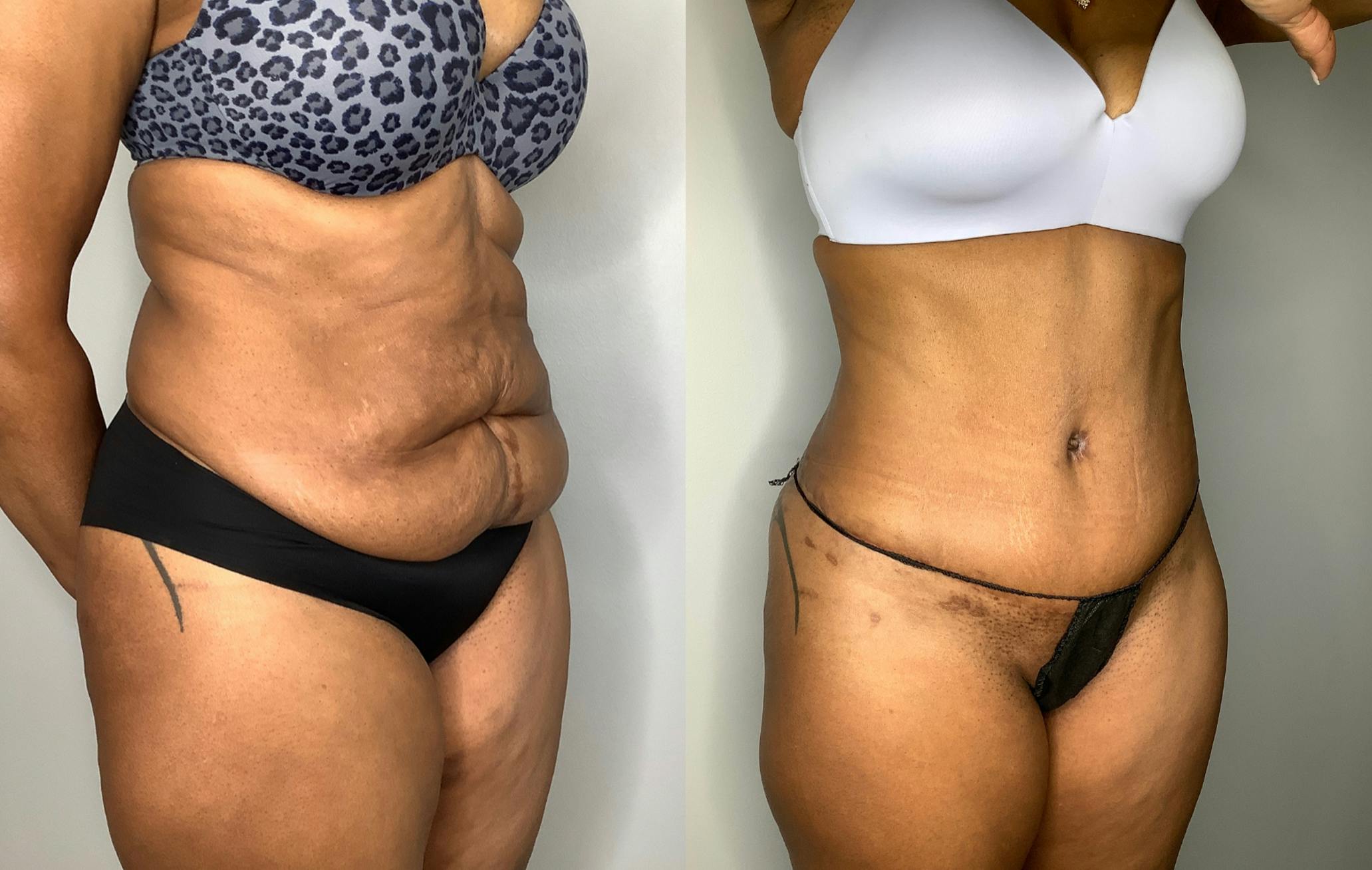patient before and after photo of a tummy tuck in Houston - 03