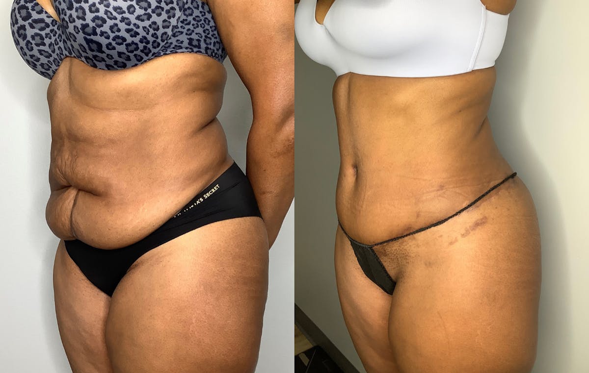 Liposuction Before & After Gallery - Patient 57580351 - Image 4