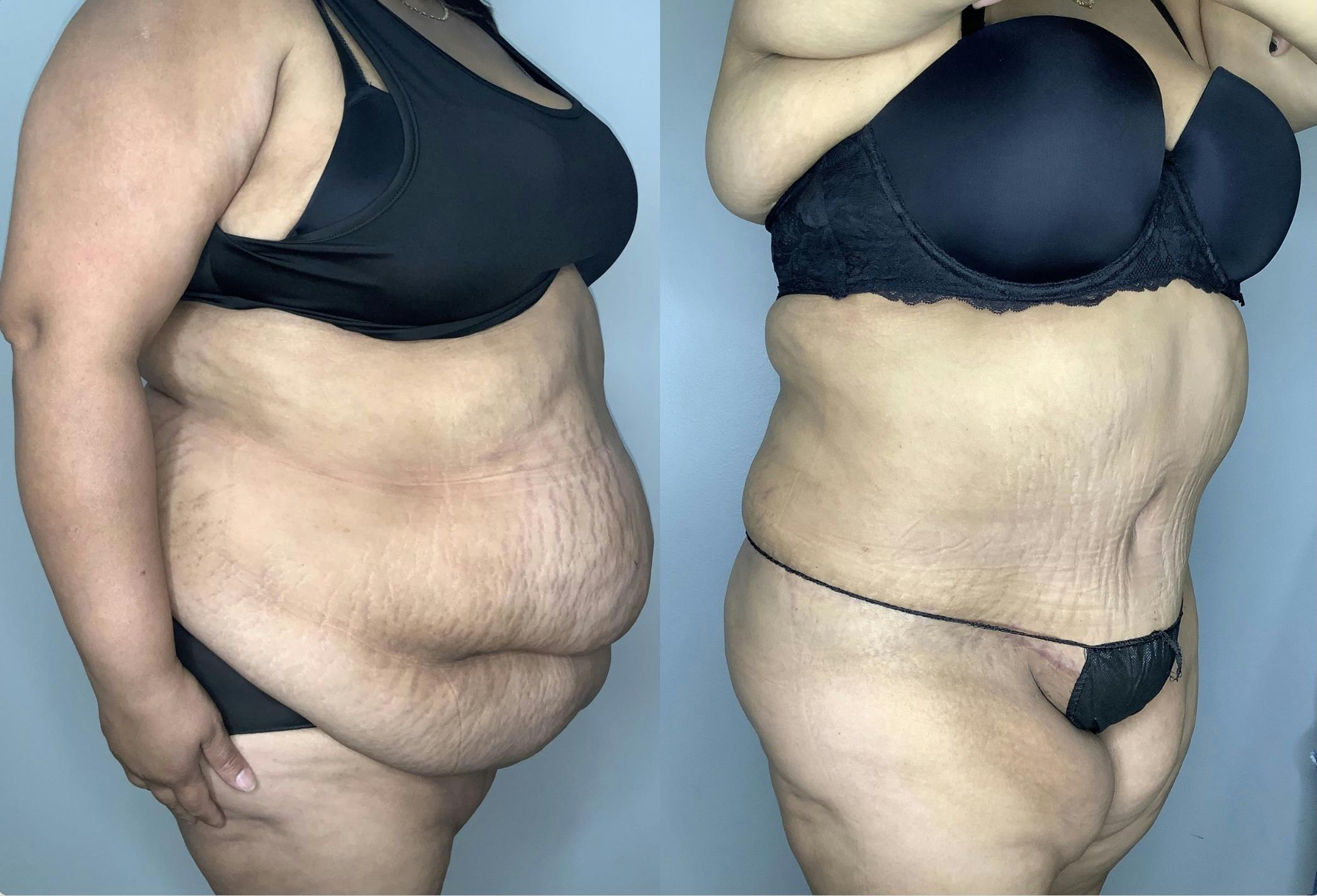 Tummy Tuck Before & After Gallery - Patient 68004124 - Image 4