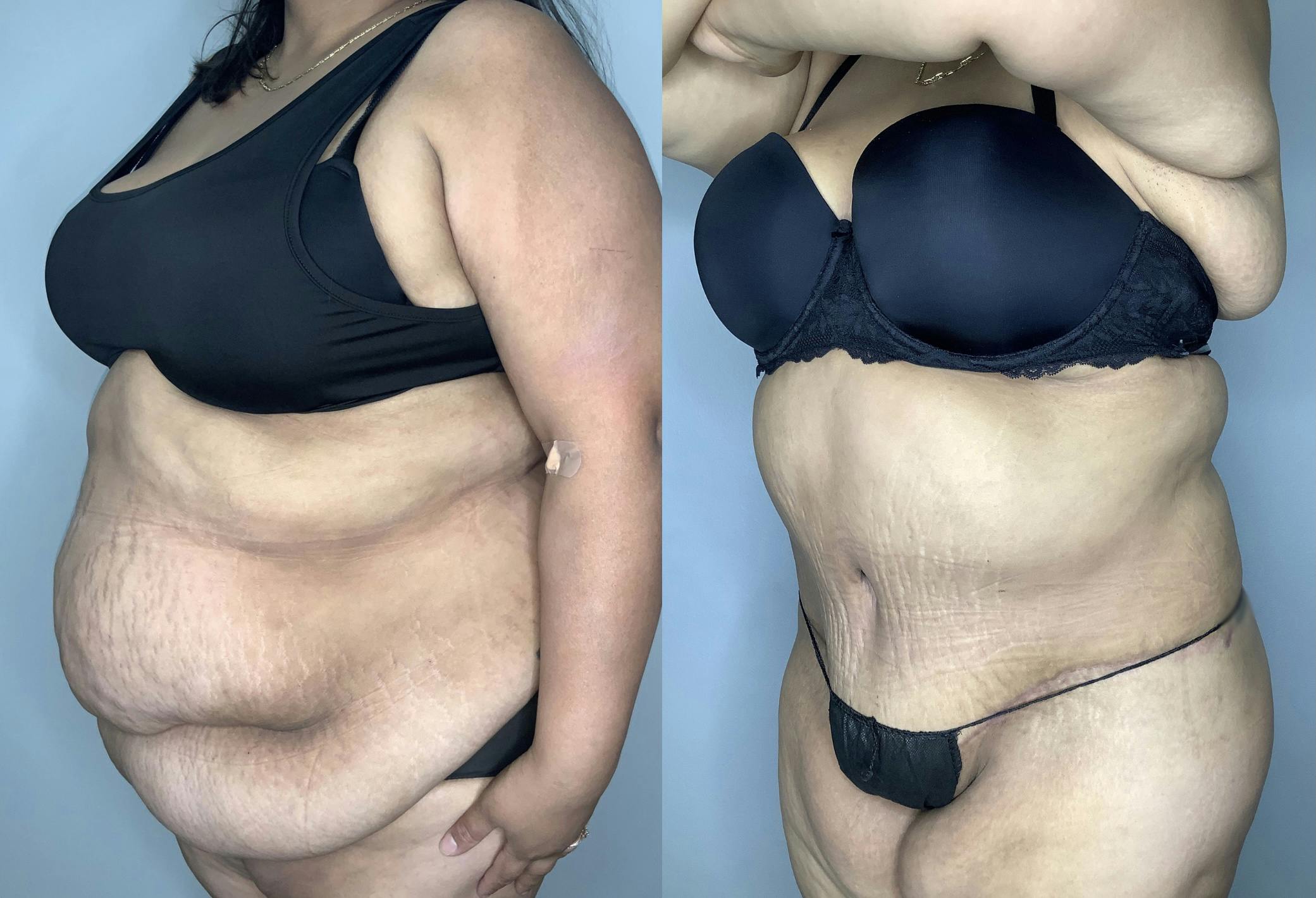 Liposuction Before & After Gallery - Patient 68004101 - Image 4