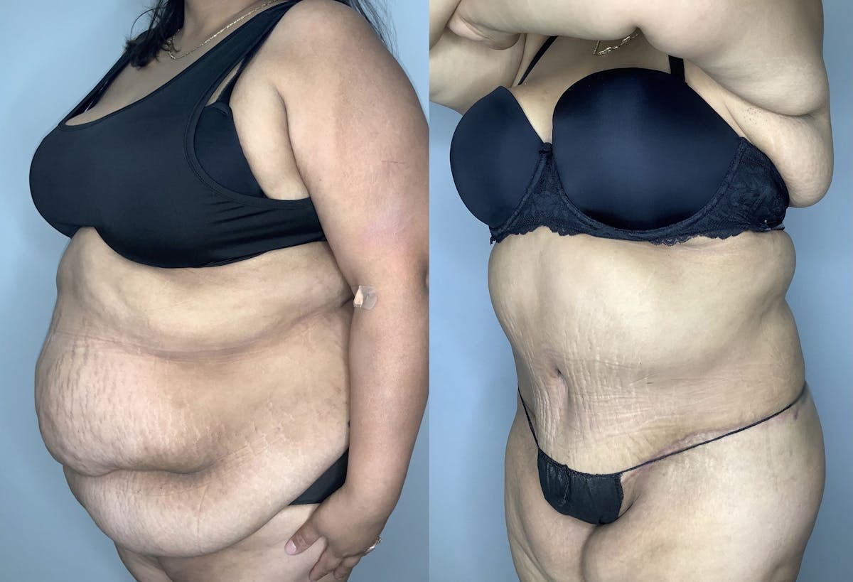Tummy Tuck Before & After Gallery - Patient 68004124 - Image 2