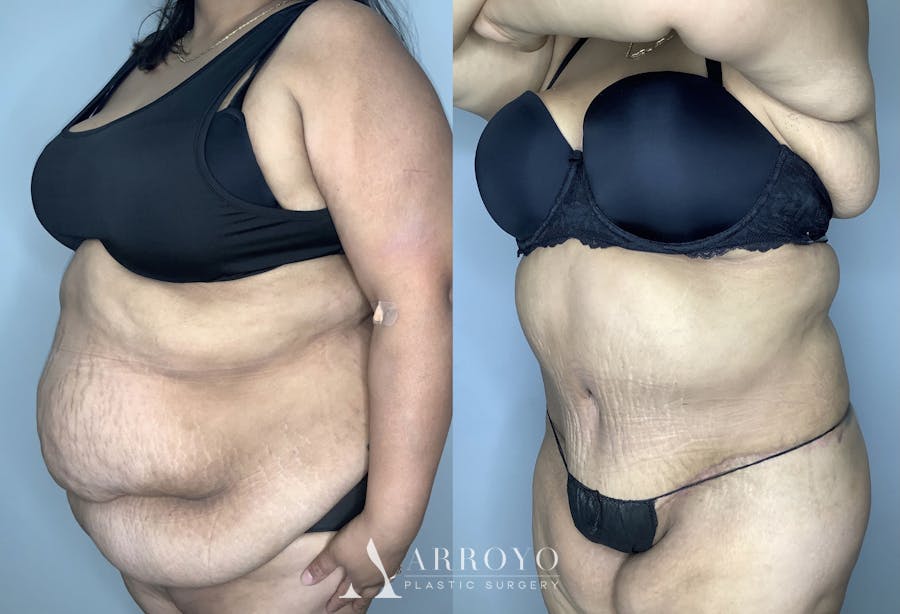 Tummy Tuck Before & After Gallery - Patient 68004124 - Image 2