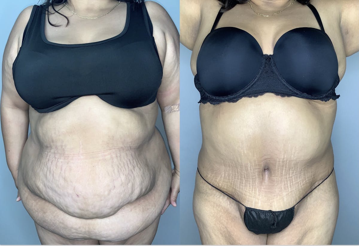 Tummy Tuck Before & After Gallery - Patient 68004124 - Image 1