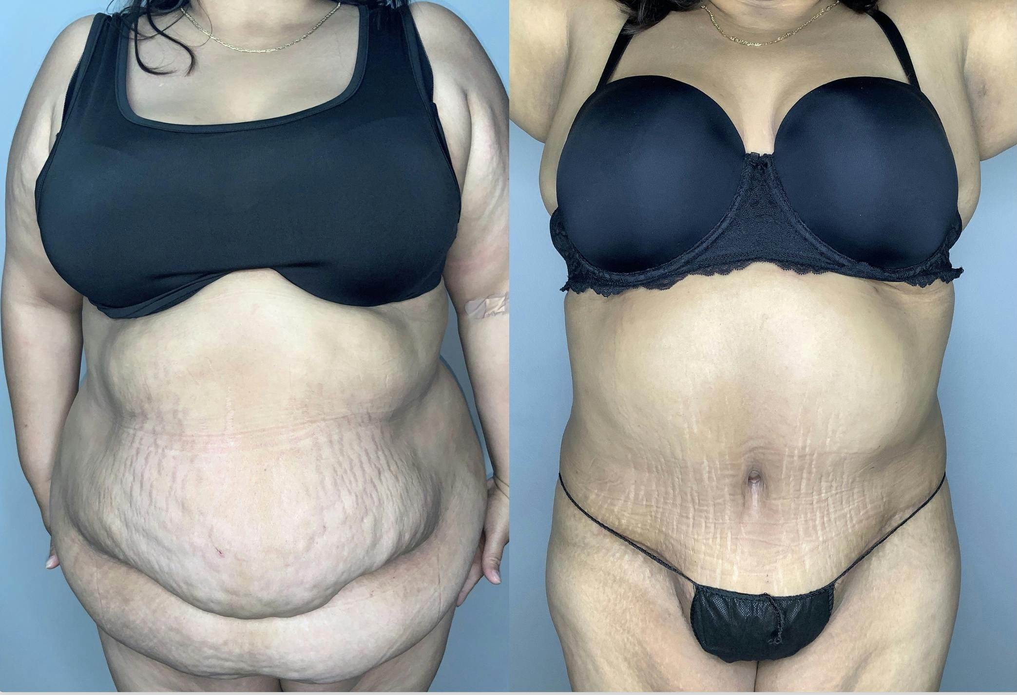 Liposuction Before & After Gallery - Patient 68004101 - Image 1