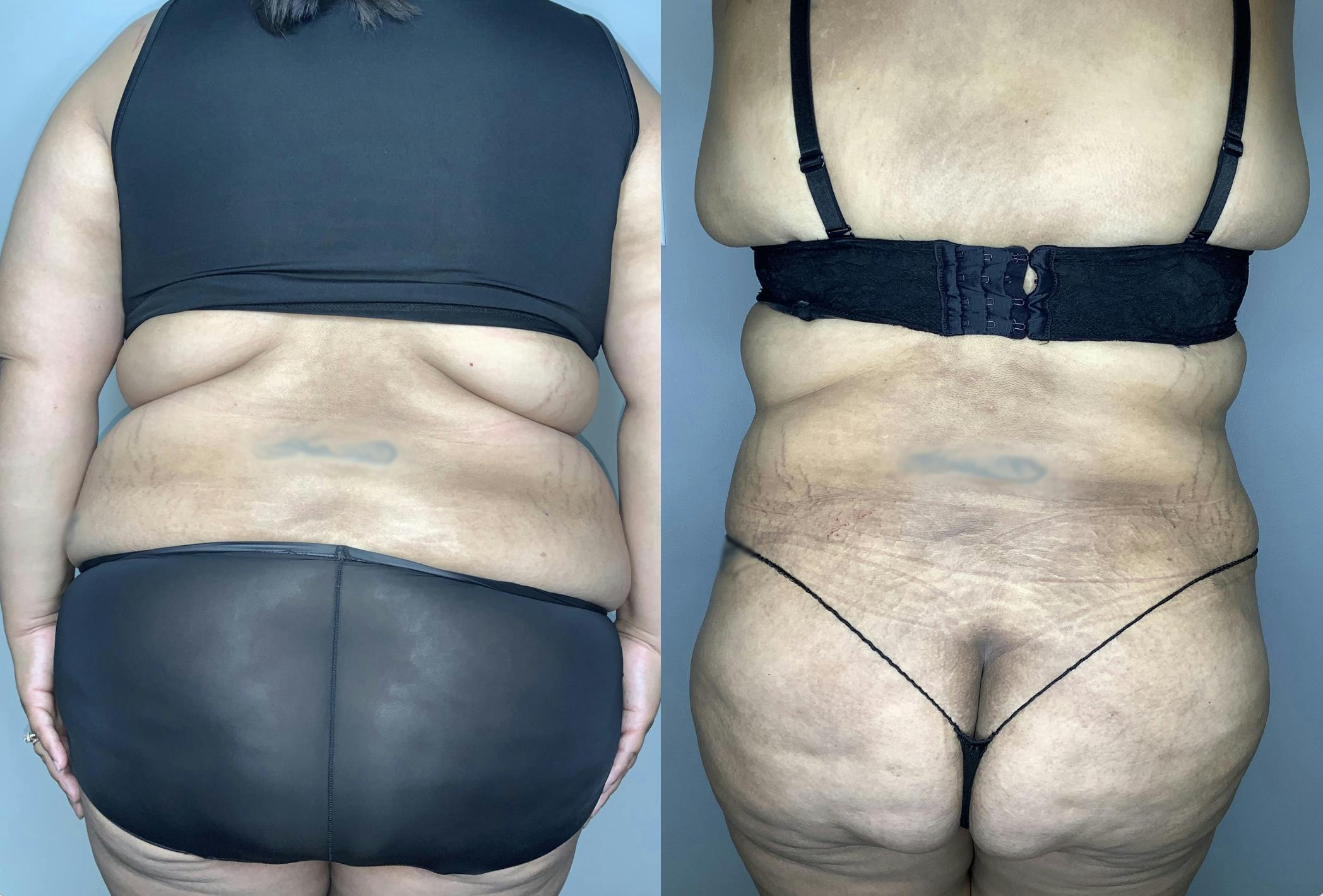 Tummy Tuck Gallery - Patient 68004124 - Image 6