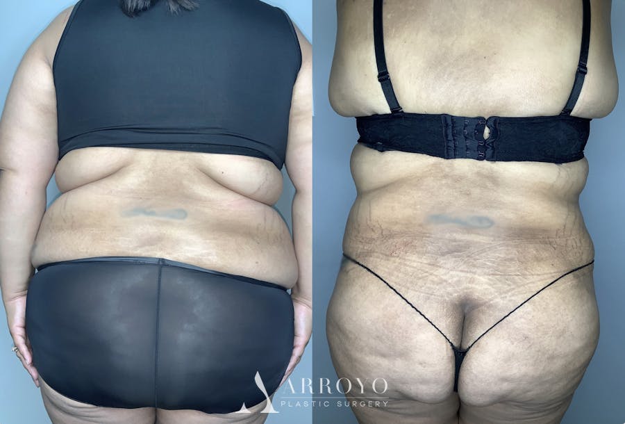 Tummy Tuck Before & After Gallery - Patient 68004124 - Image 6