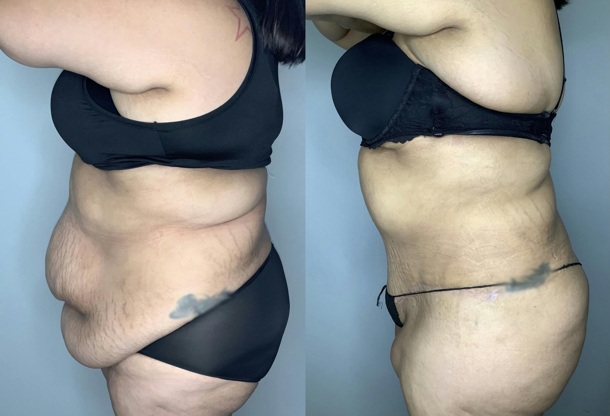 Tummy Tuck Gallery - Patient 68004124 - Image 3