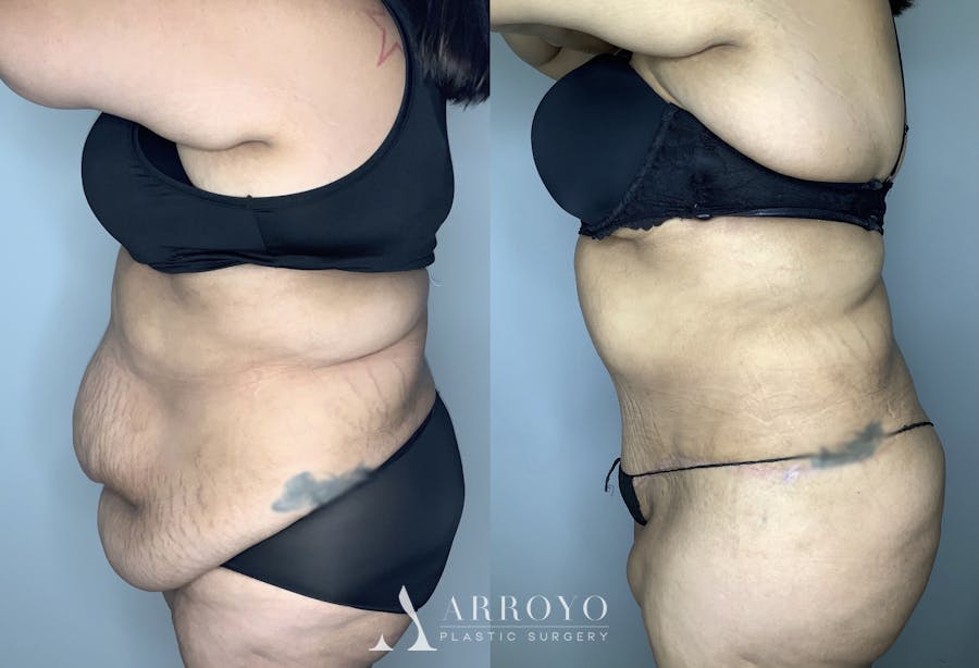 Tummy Tuck Before & After Gallery - Patient 68004124 - Image 3