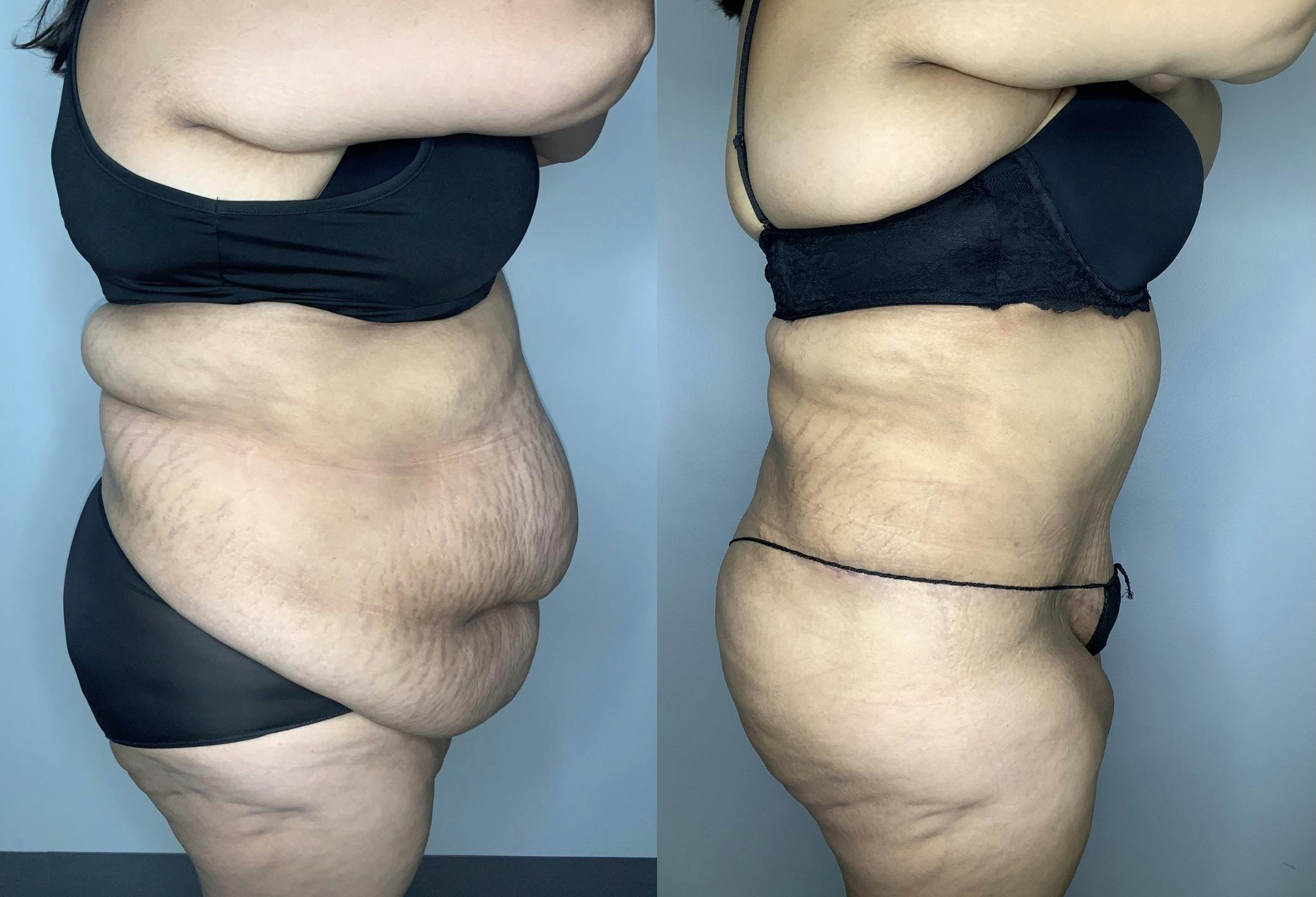 Liposuction Before & After Gallery - Patient 68004101 - Image 3