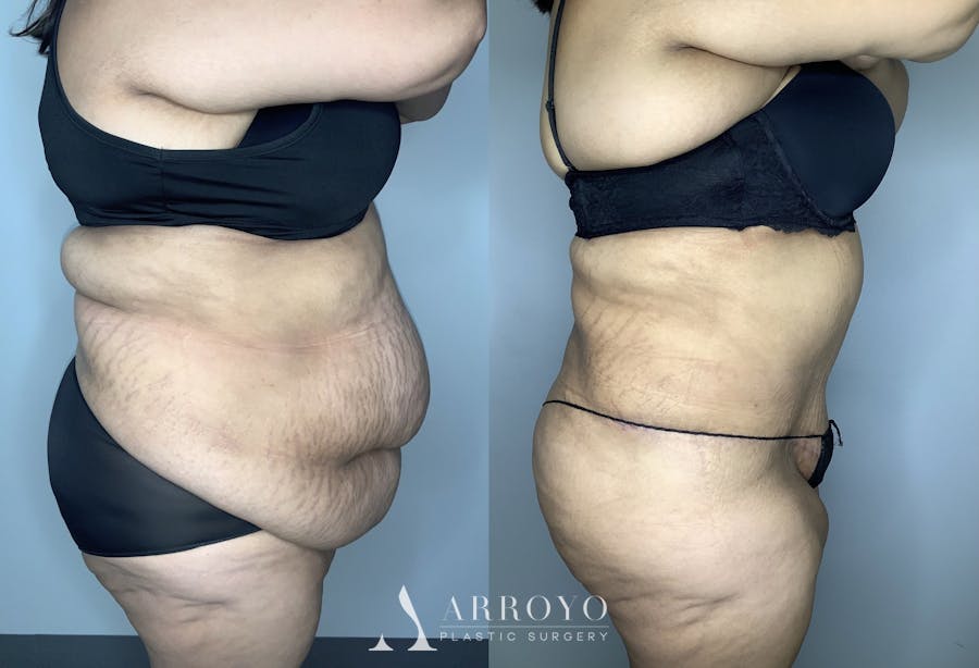 Tummy Tuck Before & After Gallery - Patient 68004124 - Image 5