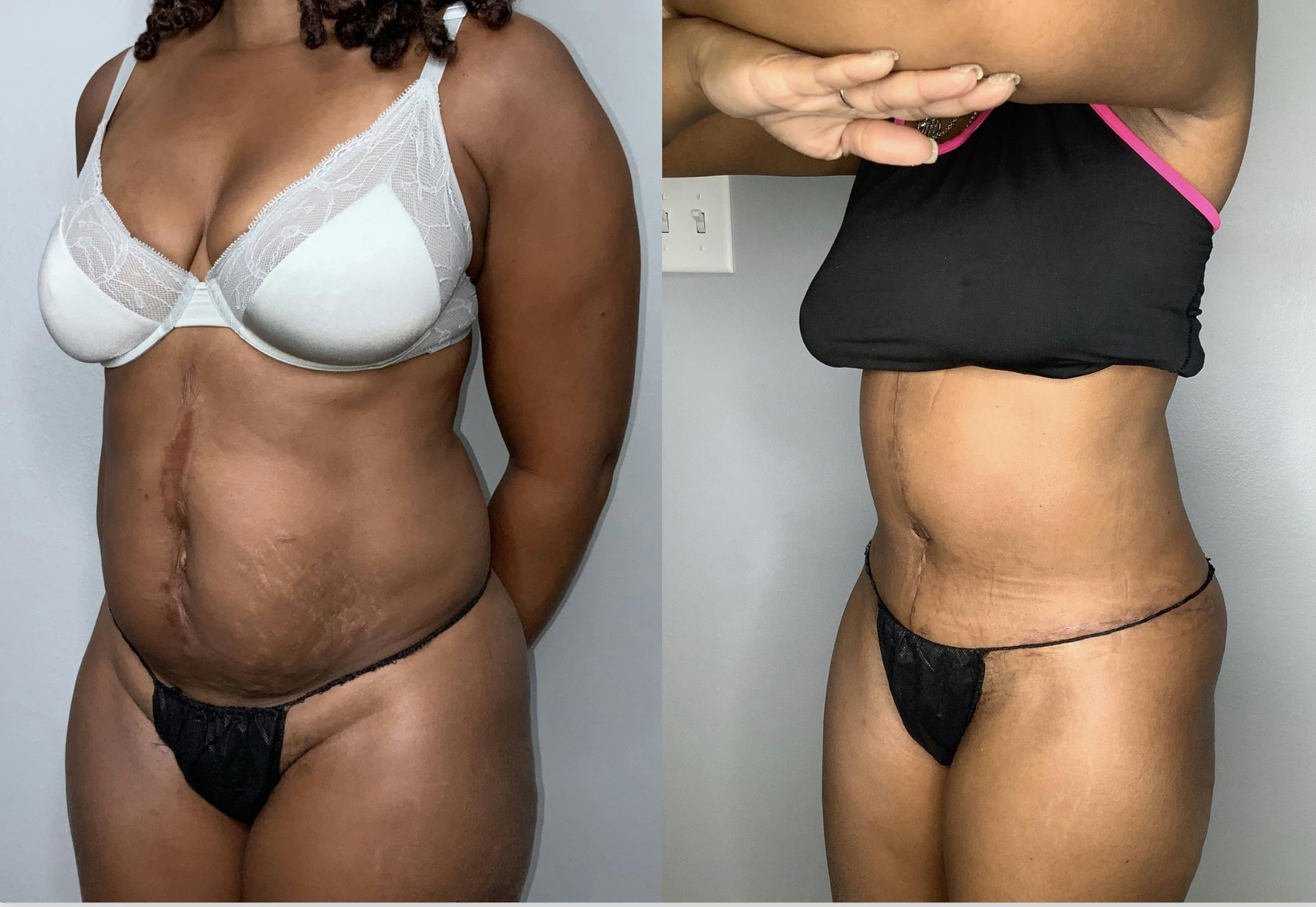 Liposuction Before & After Gallery - Patient 68004435 - Image 5