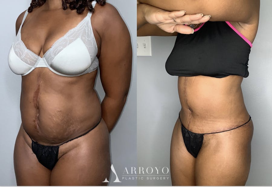 Fleur de lis Abdominoplasty Before & After Gallery - Patient 68004410 - Image 2
