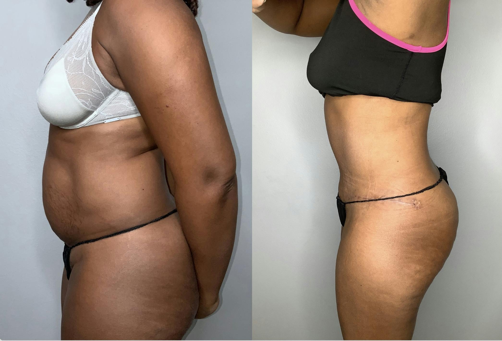 Liposuction Before & After Gallery - Patient 68004435 - Image 6