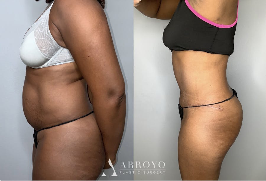 Fleur de lis Abdominoplasty Before & After Gallery - Patient 68004410 - Image 3