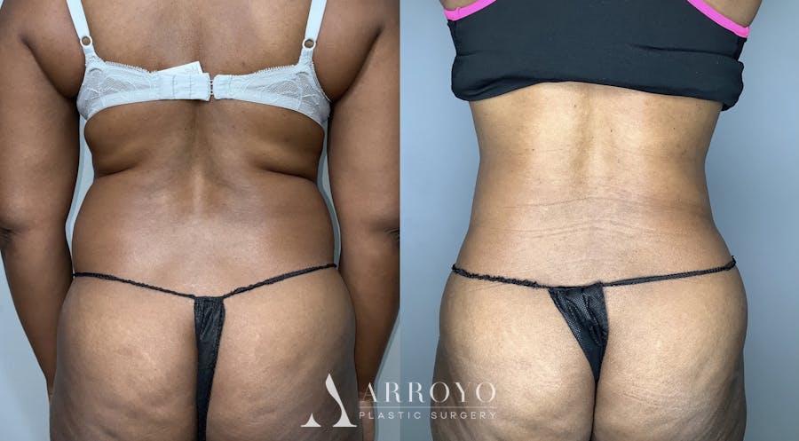 Fleur de lis Abdominoplasty Before & After Gallery - Patient 68004410 - Image 4