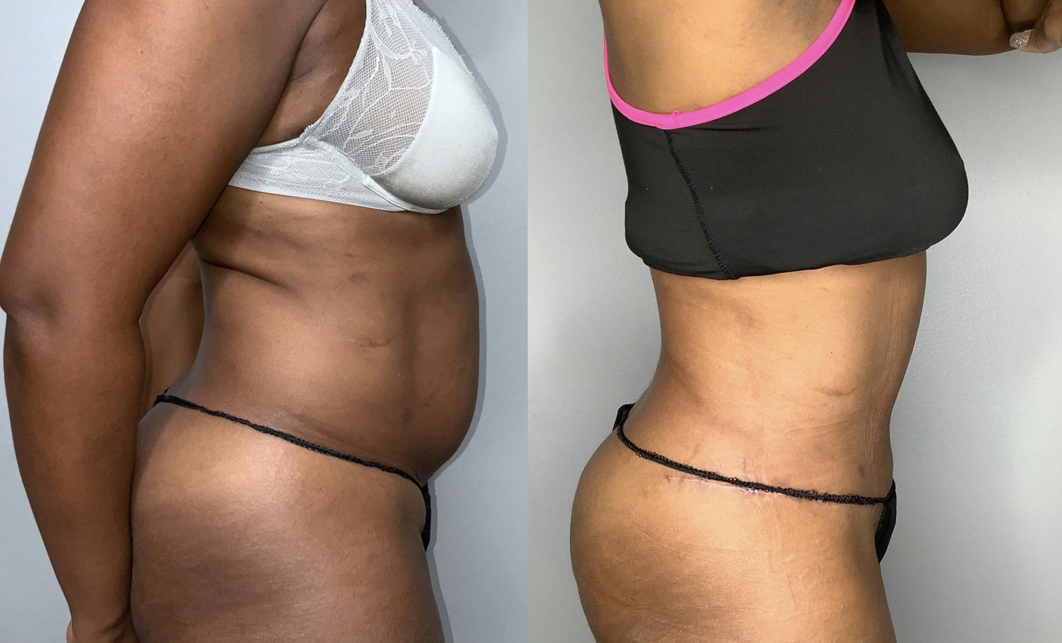 Liposuction Before & After Gallery - Patient 68004435 - Image 3