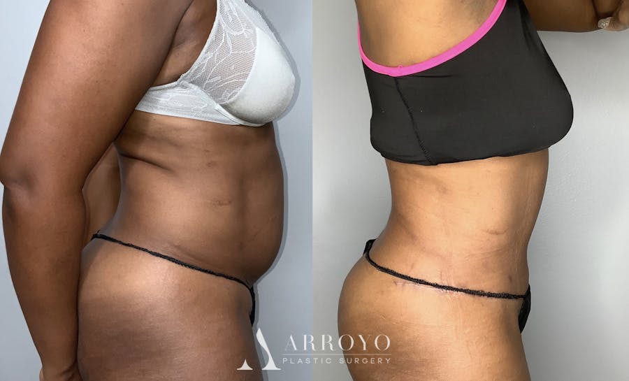 Fleur de lis Abdominoplasty Before & After Gallery - Patient 68004410 - Image 6