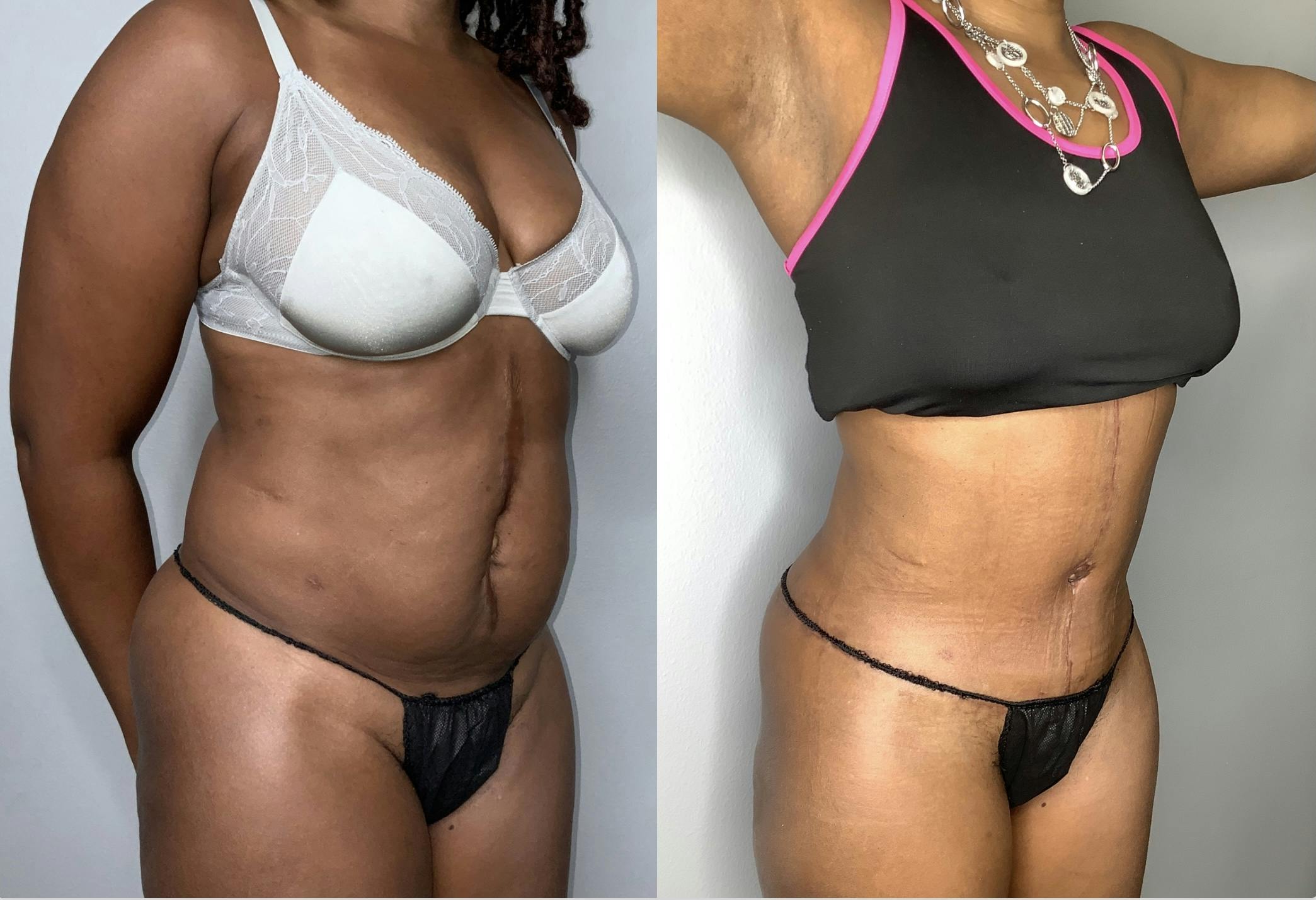 Liposuction Gallery - Patient 68004435 - Image 2