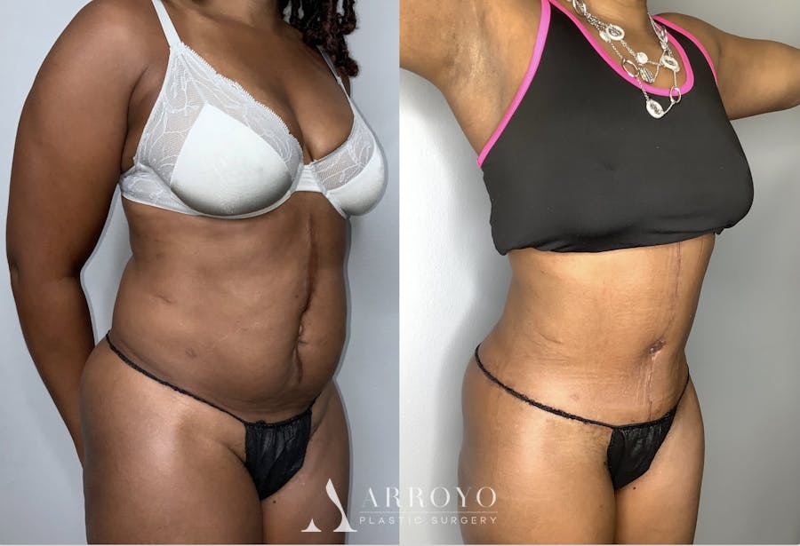 Fleur de lis Abdominoplasty Before & After Gallery - Patient 68004410 - Image 5
