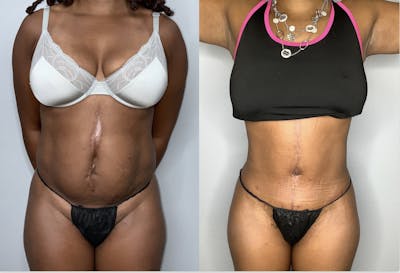 Fleur de lis Abdominoplasty Before & After Gallery - Patient 68004410 - Image 1