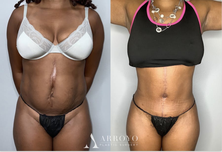 Fleur de lis Abdominoplasty Before & After Gallery - Patient 68004410 - Image 1