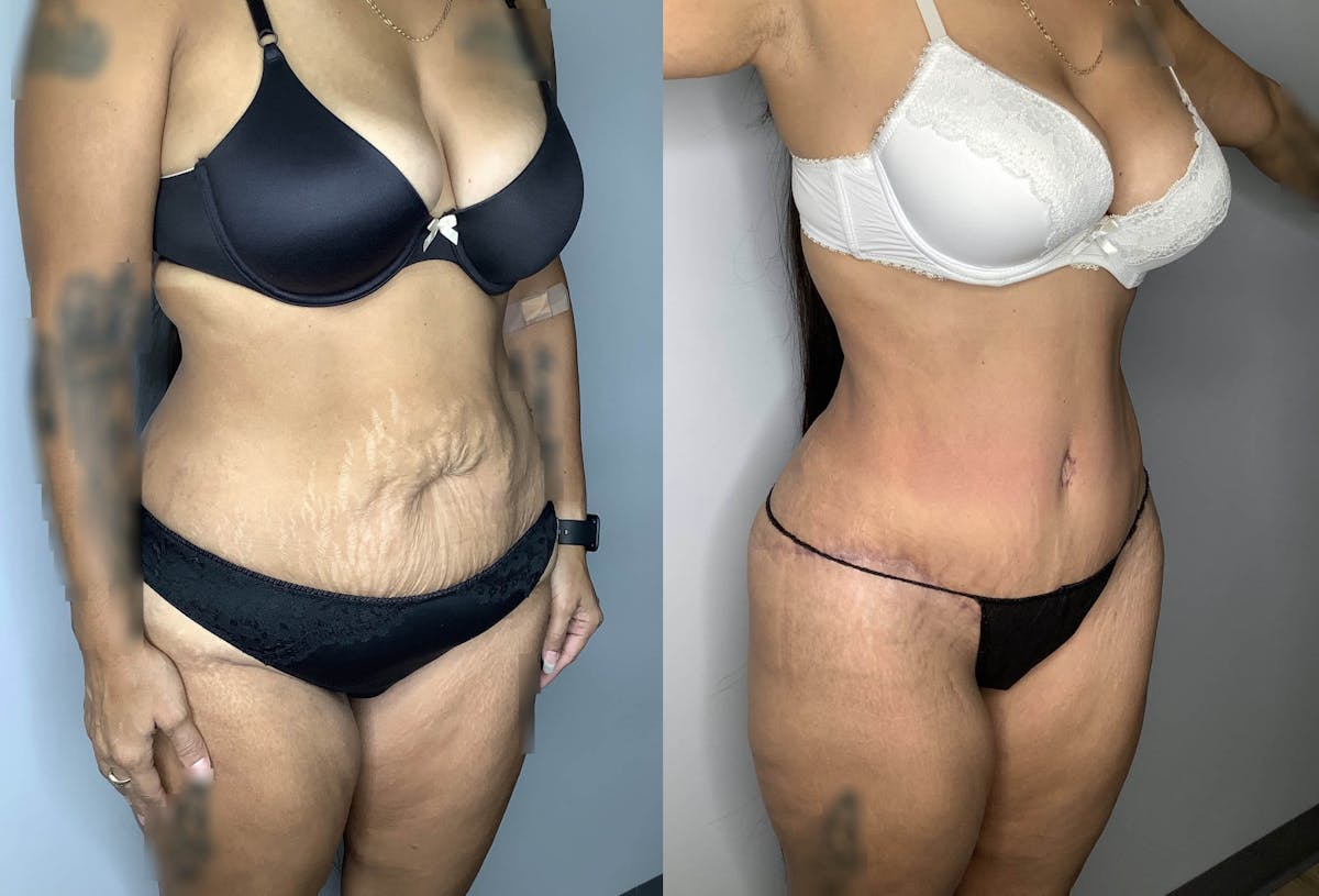 Liposuction Before & After Gallery - Patient 74007243 - Image 6