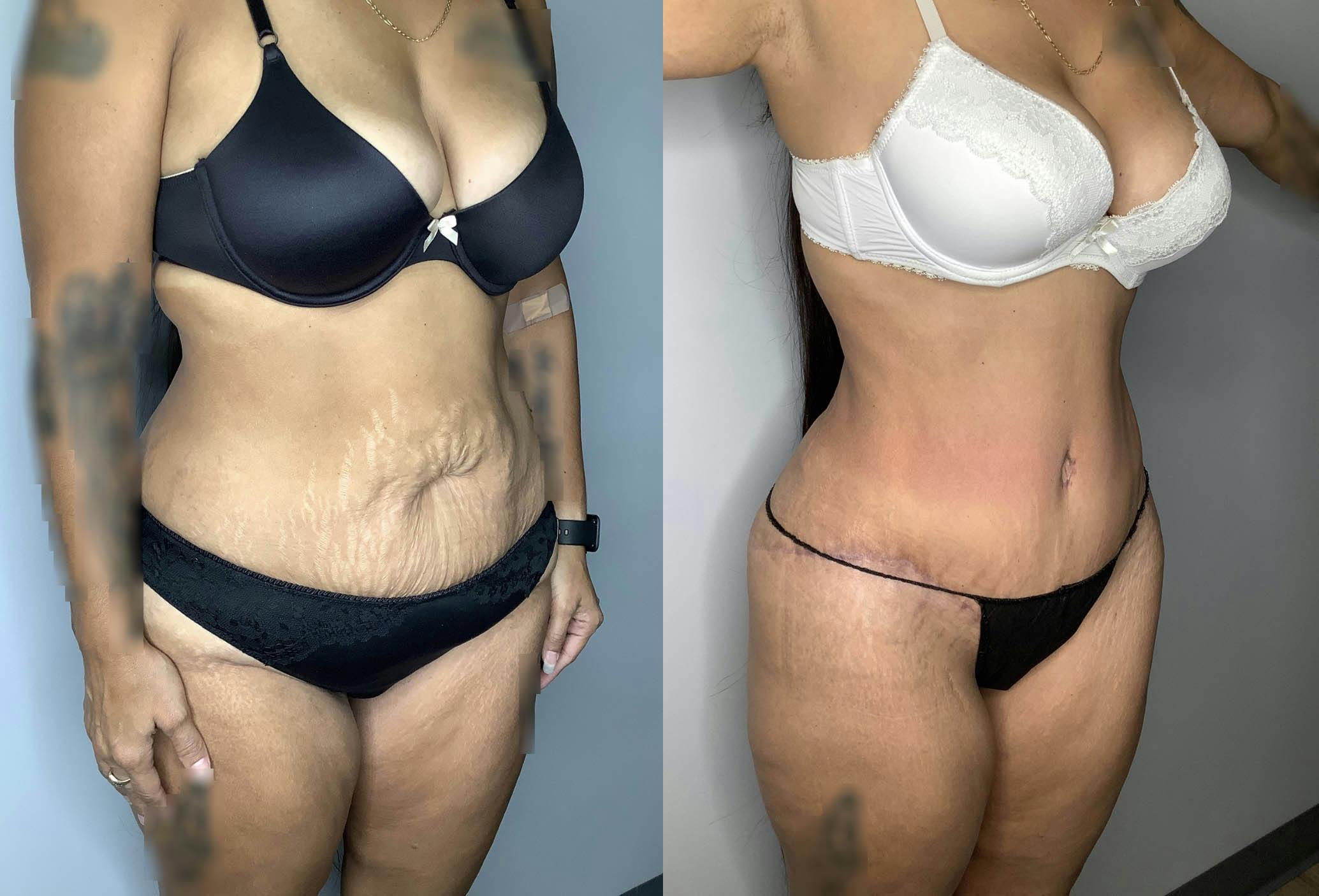 Liposuction Gallery - Patient 74007243 - Image 6