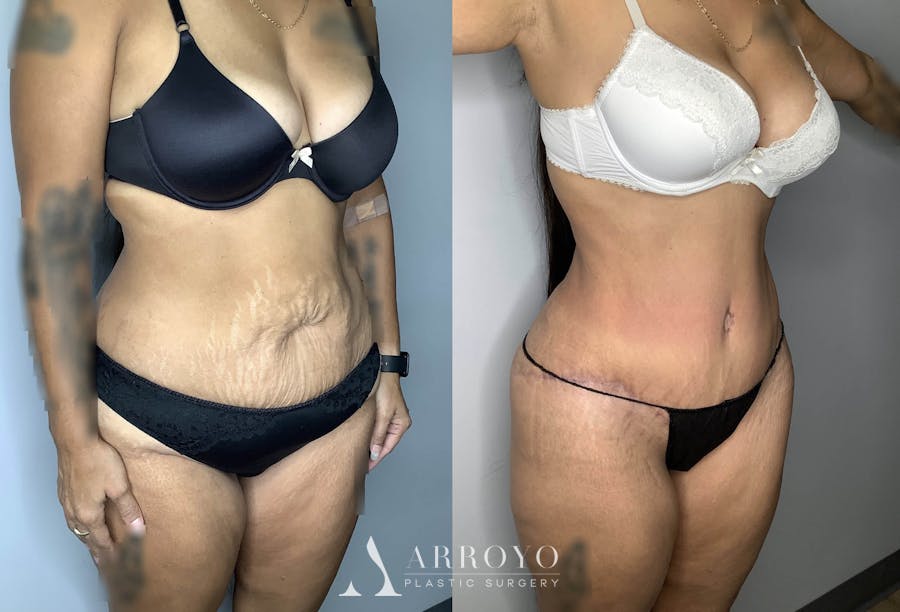 Tummy Tuck Before & After Gallery - Patient 74007230 - Image 2