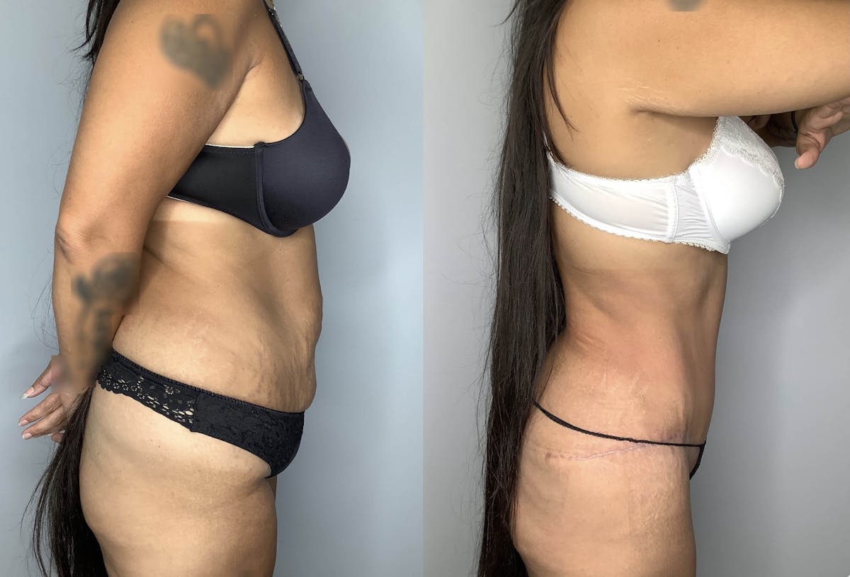Liposuction Before & After Gallery - Patient 74007243 - Image 5
